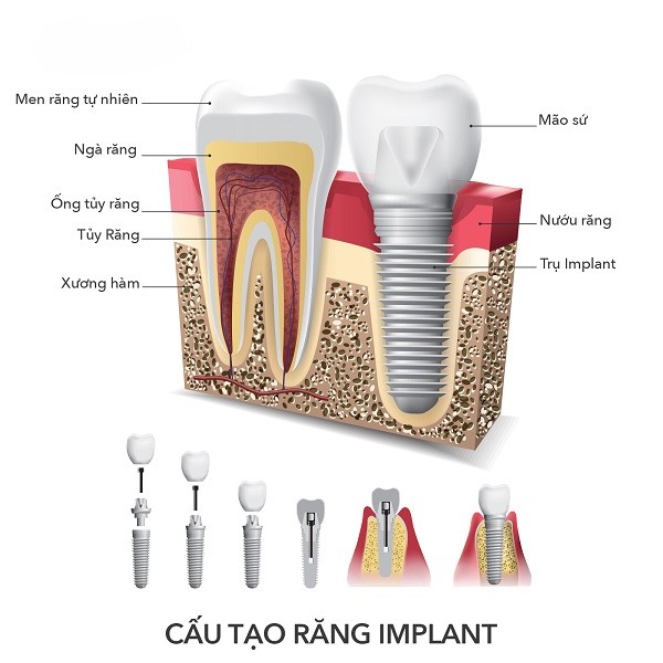 cấu tạo răng implant